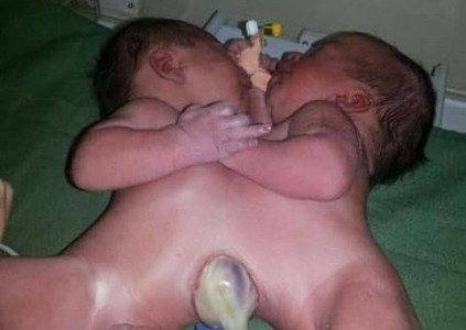 CONJOINED TWINS WEST GHOUTA